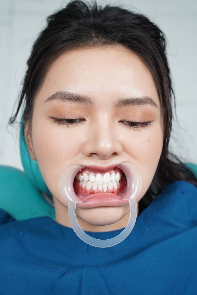 Bọc răng sứ tại Thiên Hà giúp chị Thư bảo tồn tối đa răng gốc