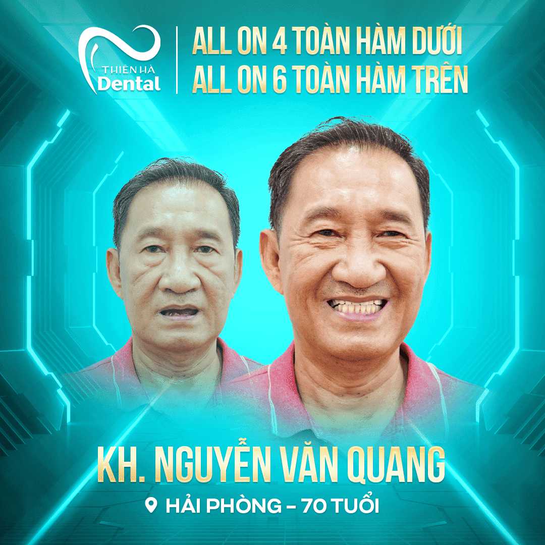 trồng implant all on 6 không đau