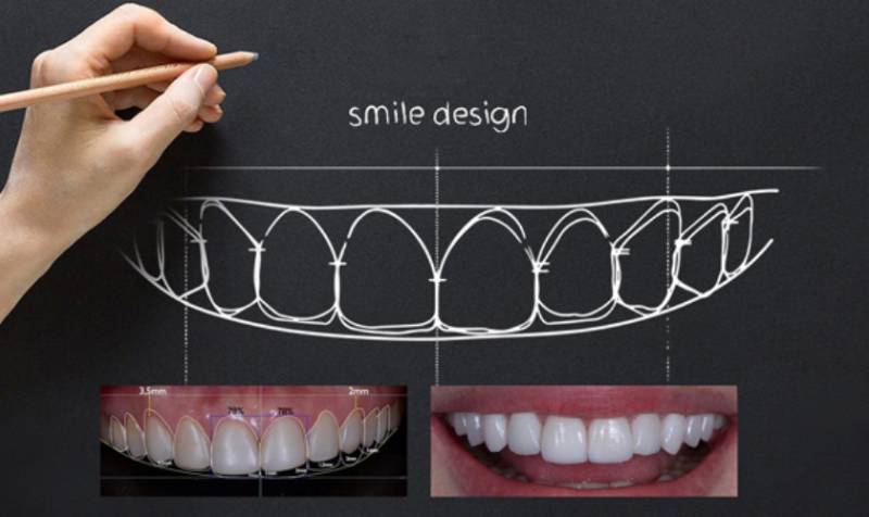 Thiết kế nụ cười hoàn hảo bằng công nghệ DSD