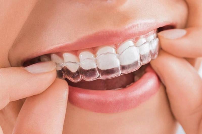 Khay niềng invisalign ôm sát cung giúp đạt tính thẩm mỹ cao