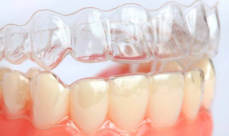 Đa số các đối tượng cần chỉnh nha đều có thể áp dụng niềng răng invisalign