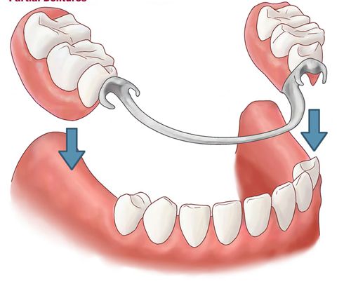 hàm giả tháo lắp tại nha khoa Thiên Hà
