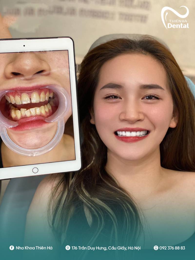 Khách hàng thăng hạng nụ cười sau khi bọc răng sứ Orodent