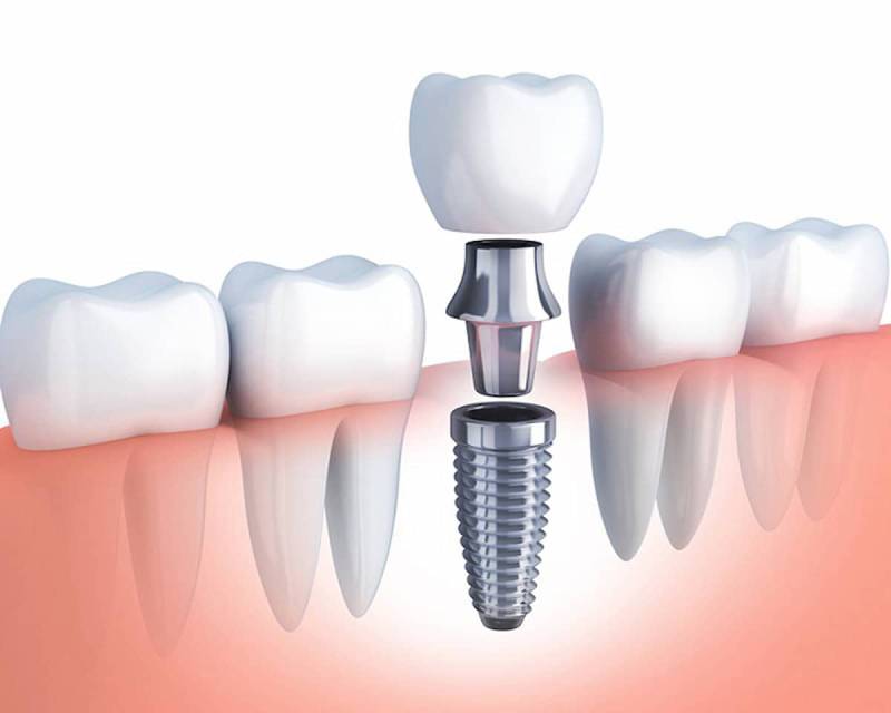 Cấy ghép implant là phương pháp giúp điều trị hiệu quả tình trạng mất răng